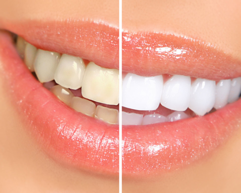 Teeth Whitening