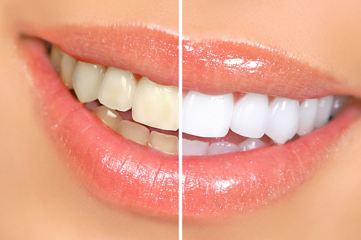 Teeth Whitening